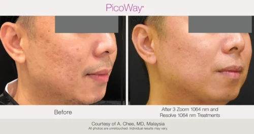 BA-PicoWay-AChee-3Tx-031