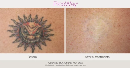 BA-PicoWay-Achung-9Tx-015