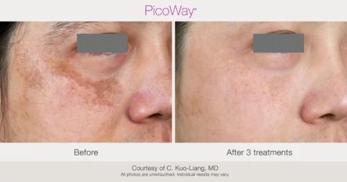 BA-PicoWay-CKLang-3x-062