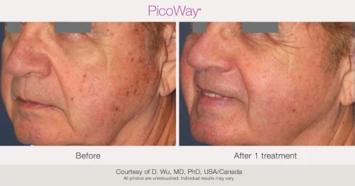 BA-PicoWay-DWu-1Tx-051